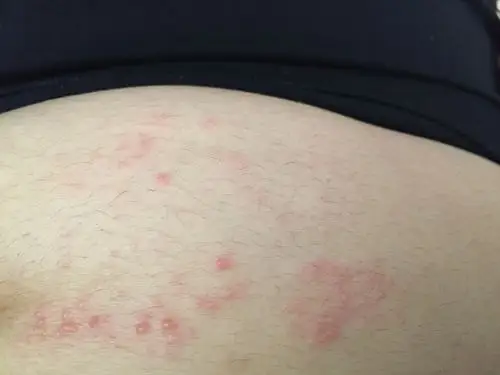 就是起小水痘一开始是红点点后来就成痘痘了