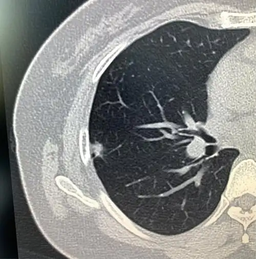 女46岁体验发现肺部阴影1个月