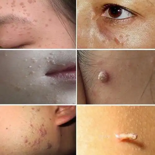 男性早期菜花状肛门尖锐湿疣图片_有来医生