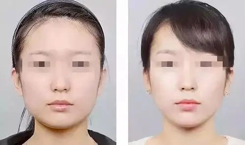 脸大是什么感受瘦脸针帮你解决