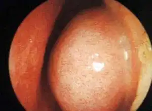 过敏性鼻炎会对人体产生哪些危害