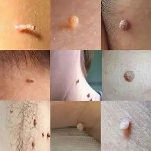 0019人付款天猫去疣药膏小肉粒扁平疣去除膏鸡眼肉刺净疣瘊净刺猴手部