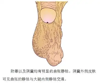 侧精索静脉曲张