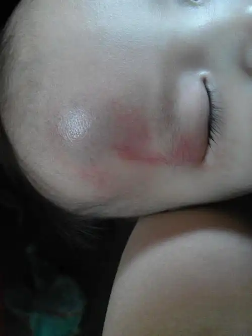 宝宝额头摔出个大包,该怎么做?