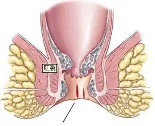 肛门口有个肉球突出是怎么回事?_危害_症状_肛肠