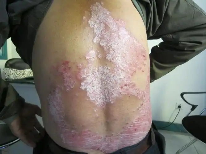 青年牛皮癣预防方法是什么_预防_疾病常识_牛皮癣银屑病_慢性病健康网