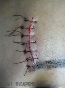 什么样的缝合才算是美容缝合?