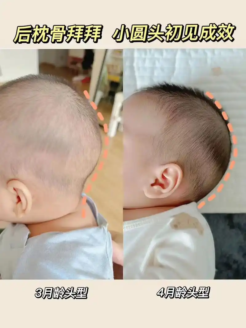 婴儿后脑勺骨头凸起图 枕骨 - 抖音