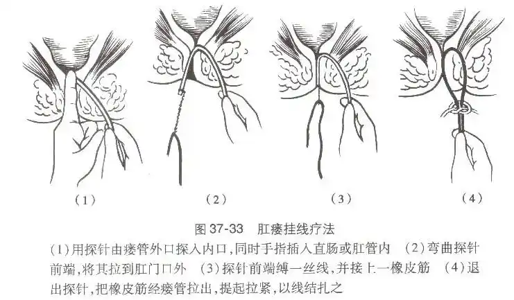 疾病搜索 外科 肛瘘    手术在骶管麻醉或局麻下进行,将探针自外口