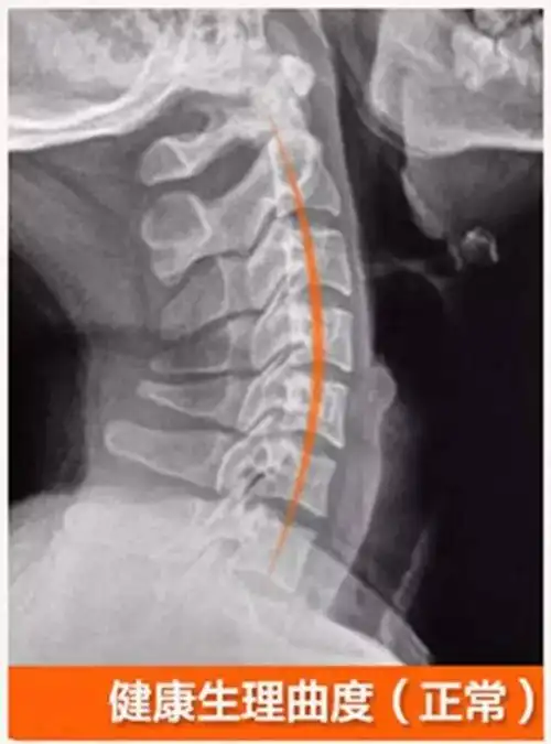 人体正常的颈椎骨受生理需要,存在弯曲弧度.