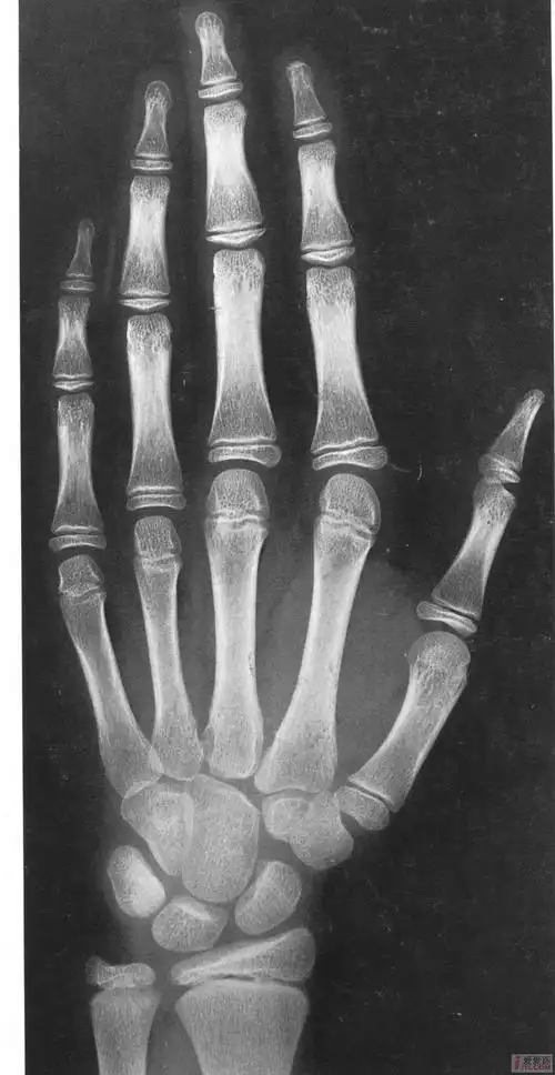 中国儿童标准骨龄片