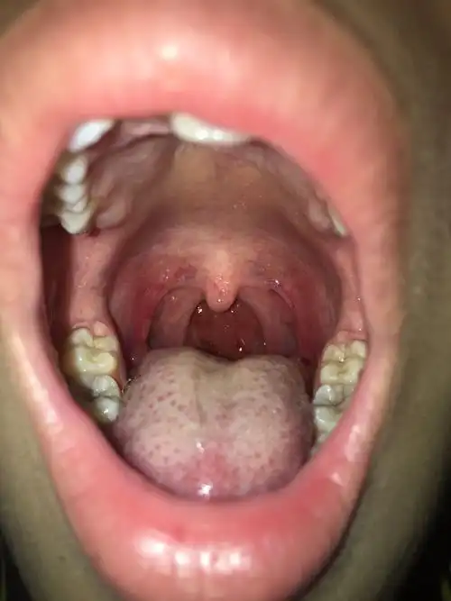 男孩15岁,嗓子红