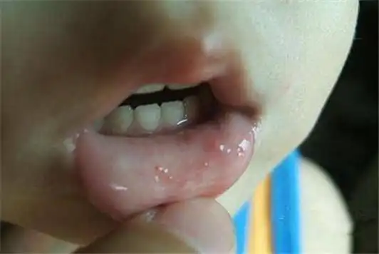 早期轻微手足口病症状图片手足口病vs水痘咽峡炎区别