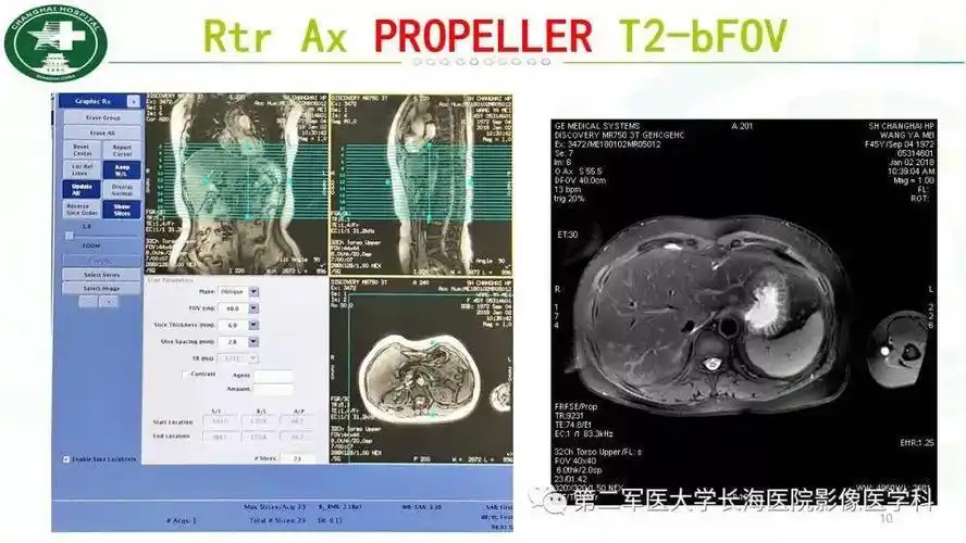 胰胆管水成像mrcp磁共振扫描规范