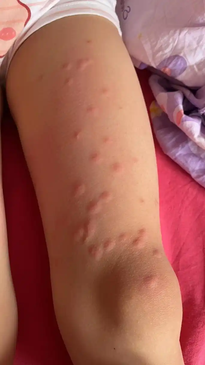 女儿身上的疮,很痒,看了好心疼,也去医院看了,医生说过敏,搞了吃的药