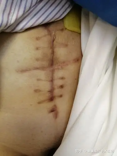 谦谦海扶手术医师 肿瘤外科,专注胰腺癌乳腺癌子宫肌瘤等实体肿瘤的