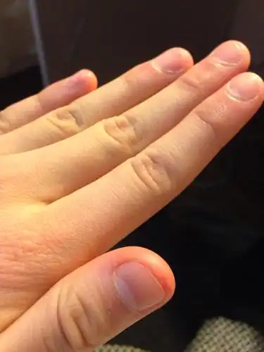 手指尖很难看,想请教一下有没有什么方法可