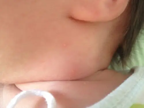 出生半个月的宝宝,脖子上有小点点白色的,很小,有图片,求助