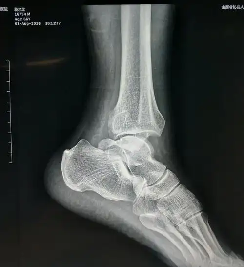 左侧踝关节骨折ser4