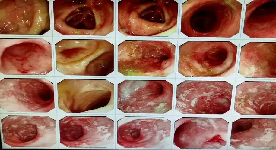 青玉散使中重度广泛结肠型溃疡性结肠炎患者重拾信心