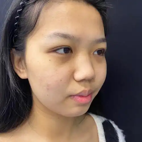 我是典型的大鼻头,鼻子又扁又宽,别人都说这种鼻子的_圈子-新氧美容