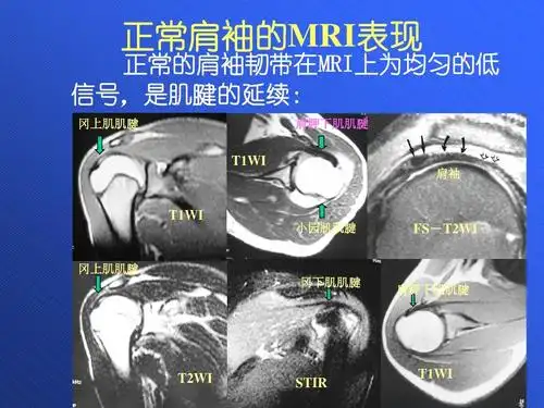 肩关节mri