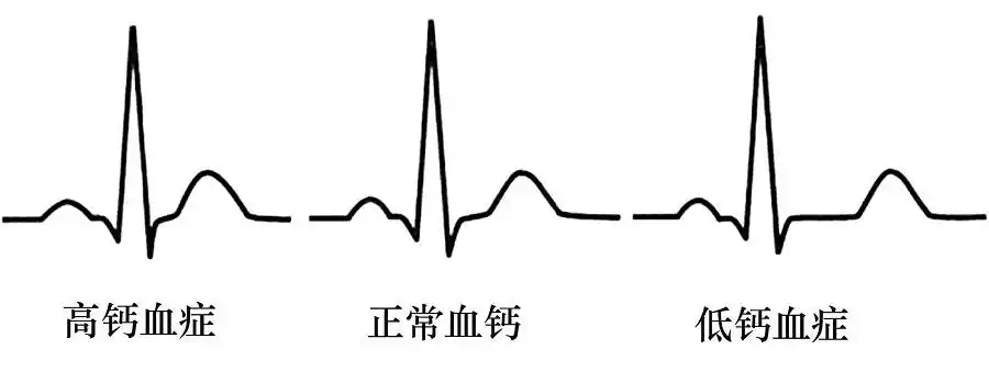 图5  血钙对心电图的影响