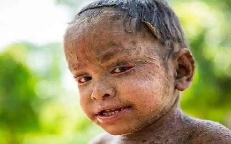 罕见的火棉胶婴儿是重症吗