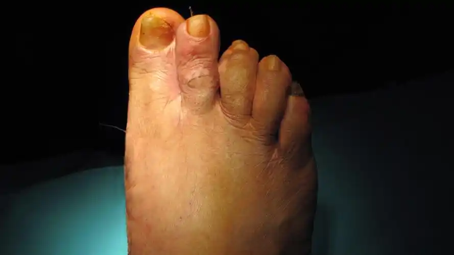 踇外翻叠趾畸形 术前术后 对照图 - 好大夫在线