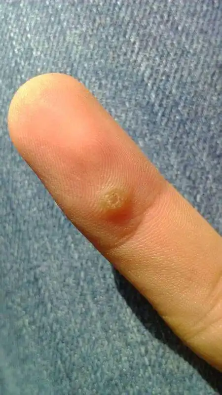 疣图片(疣图片脚上)