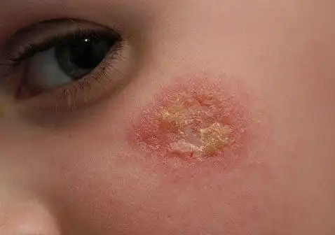 不同类型的脸上湿疹图片初期症状