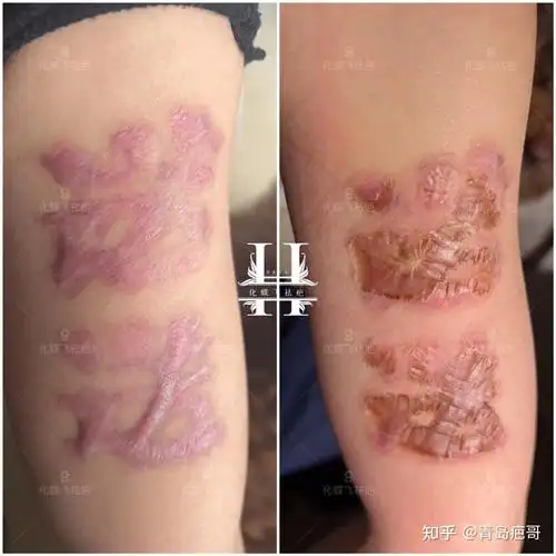 洗纹身导致的增生疤痕