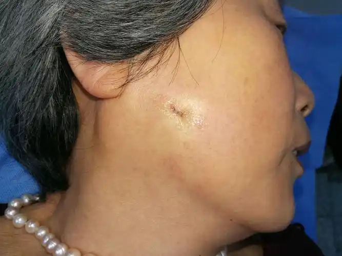 图中这位是我前两周手术的一位患者,囊肿长这么大再切除留下的疤痕