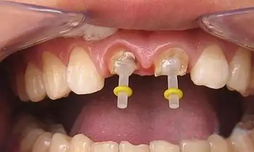 在深圳做根管治疗后医生说要桩冠修复是什么