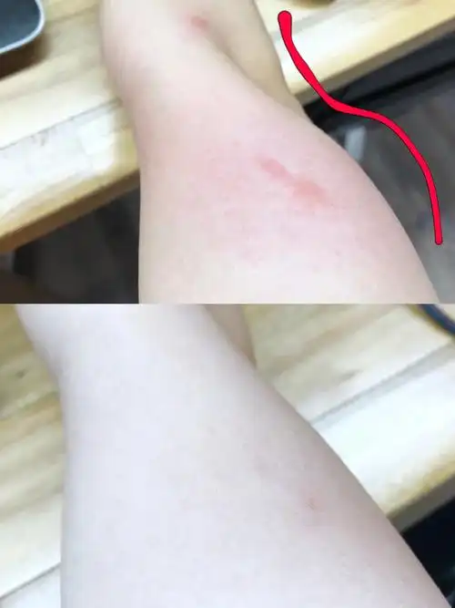 猪蹄的样子,又痒又烫,而且由于过肿,还会出现皮肤酸胀等可怕的后果