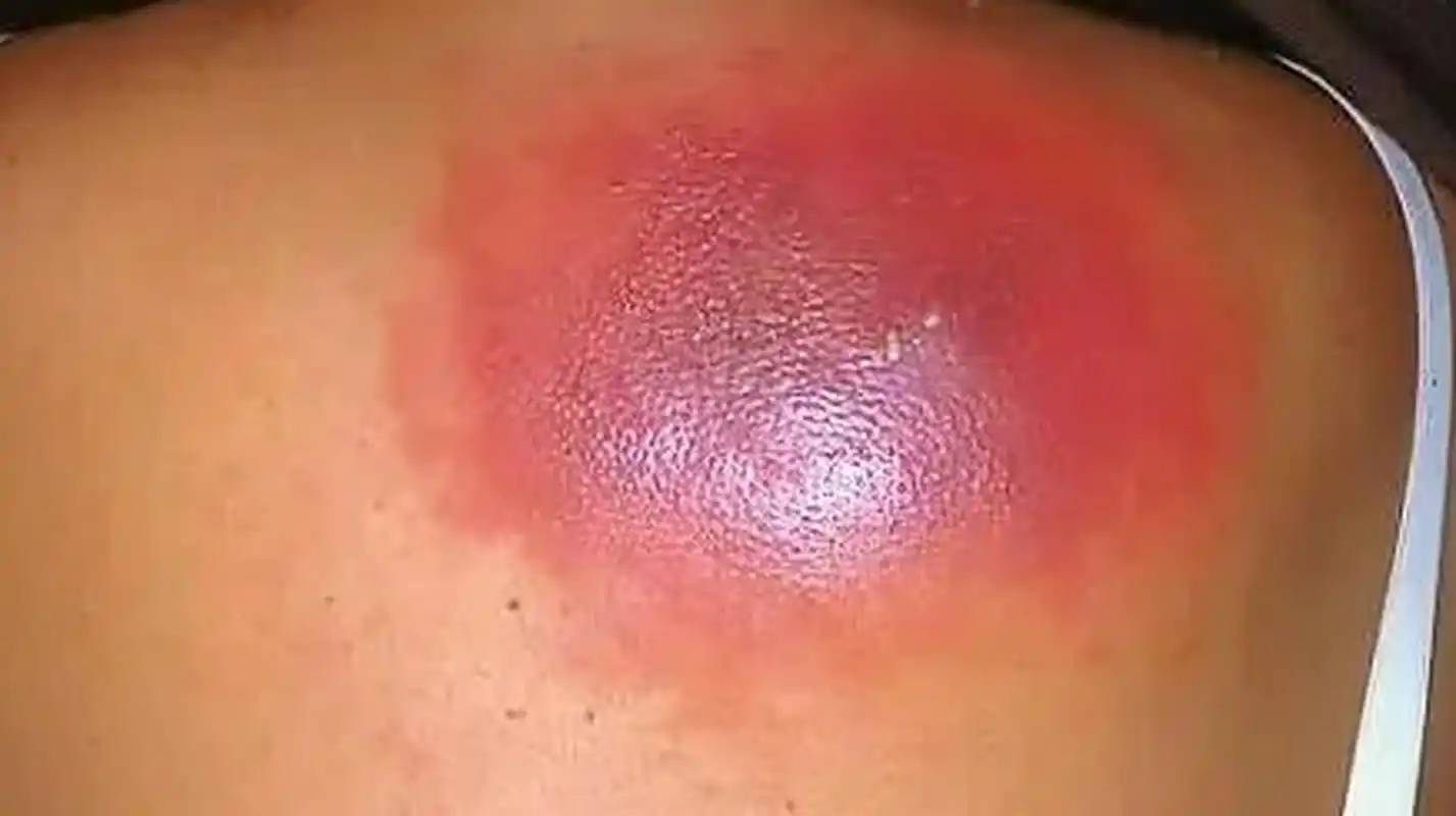 我妈后背长了个大疙瘩,她今年62岁了,我看着感觉是脂肪瘤,可是我问我