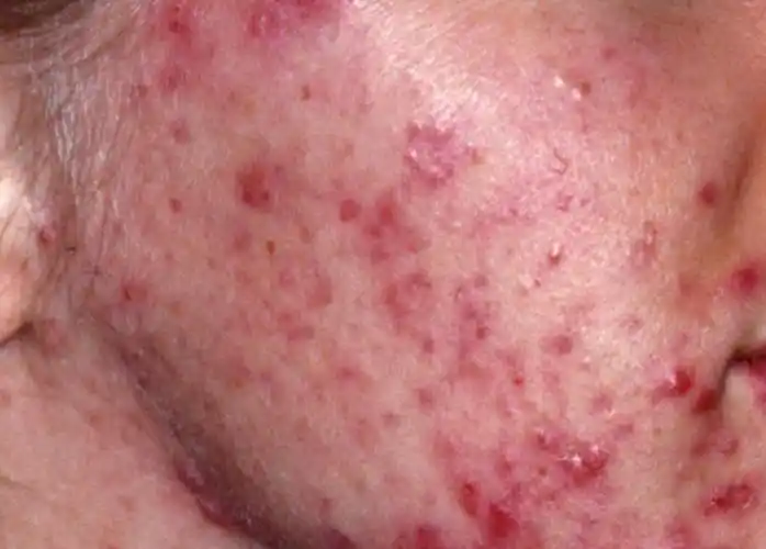 中重度痤疮,「口服异维a酸」分别用多大剂量?