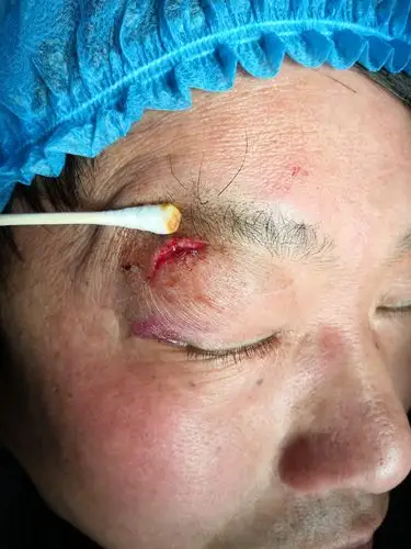 各种眼睑裂伤术前,术后对比. - 好大夫在线