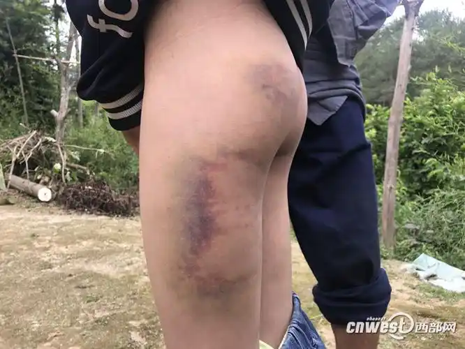 城固9岁学生身上多处淤青 竟是班主任用教棍打伤
