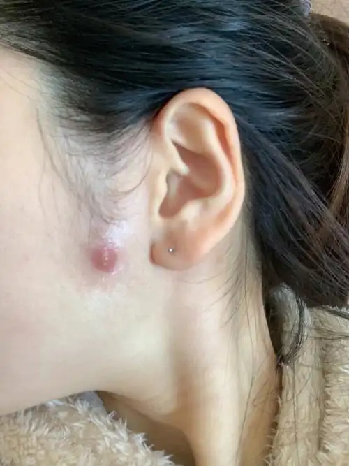 这个是火疖子吗?怎么办?