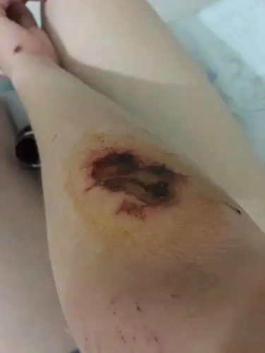 胳膊受伤结痂里面有血是不是要把血挤出来?