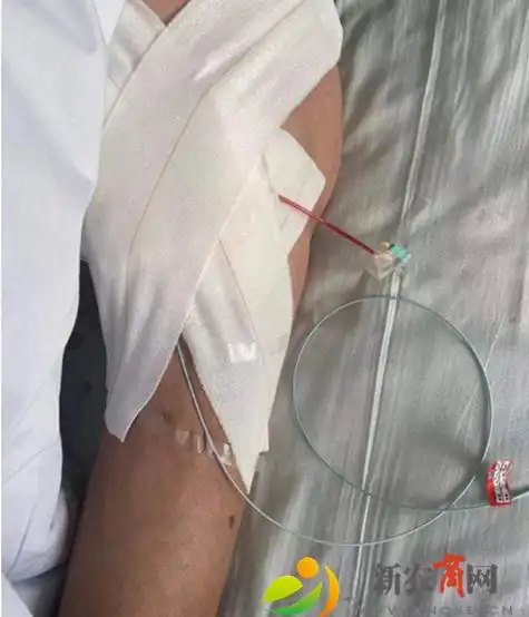 导管溶栓术是通过用导管向病人的患病处的体内注射能够溶解人体血栓的