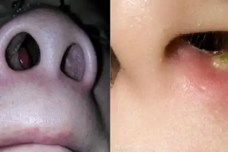 【图】鼻孔里面长脓包怎么办 教你几招轻松解决