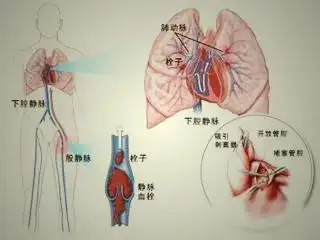 老父因抢救时剪衣服要求索赔哪知急性肺栓塞这个病多凶险