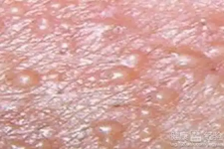 淋病淋病症状_淋病梅毒男性症状图_女性淋病白带症状