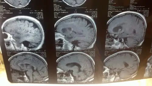 76岁脑瘤,请各位专业人士看一下磁共振图片,看看这个情况,分析一下.
