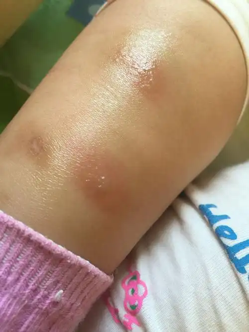 为什么每次宝宝被蚊子咬了总会起水泡呀.