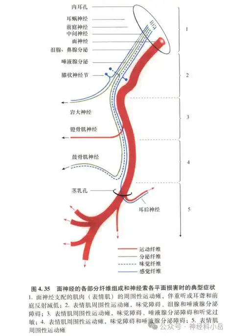 面神经炎一例 并 周围性面瘫定位诊断 及 文献复习