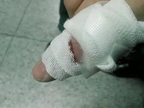 投大飞翼,手缩回来时碰到高速运转的桨,4道血口.瞬间鲜血涌出.