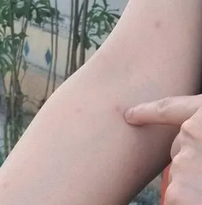 你可能是一个很长时间没有对床虱叮咬作出反应的人之一.